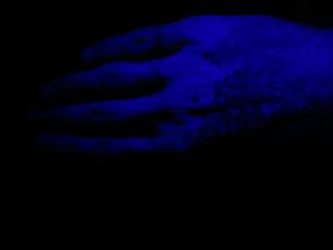 Vitiligo diagnosis under ultraviolet light